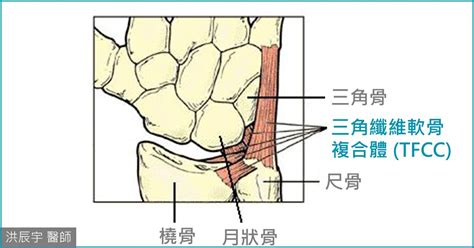 手受傷|三角纖維軟骨（tfcc）受傷怎麼治療？手腕軟骨受傷多久會好？ ∣